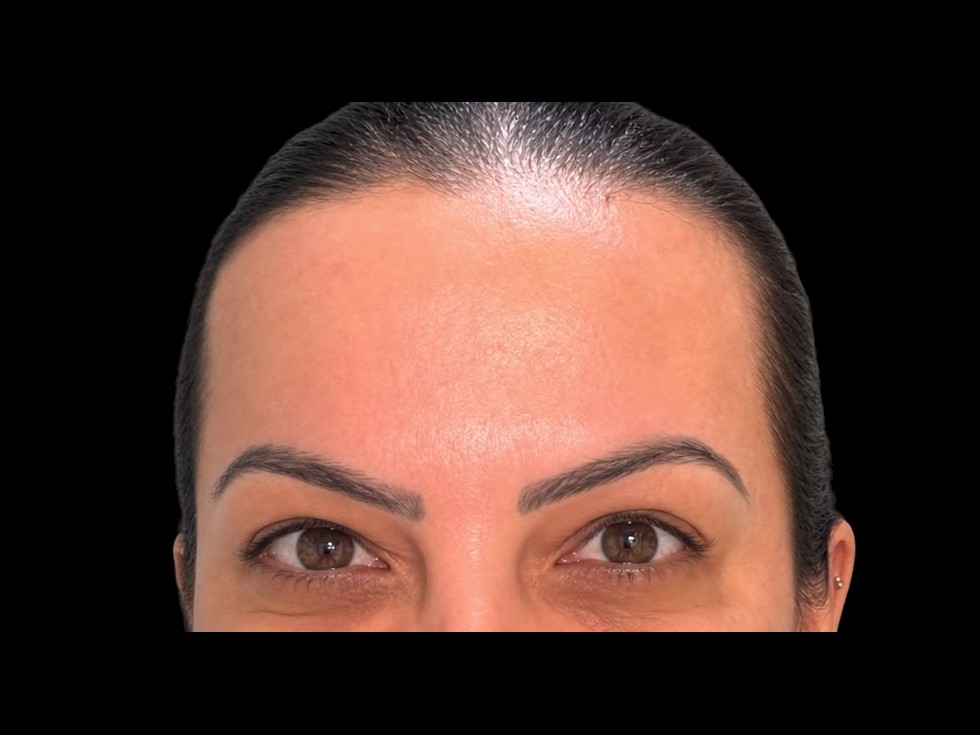 Depois — Toxina Botulínica - Botox — testa e olhar