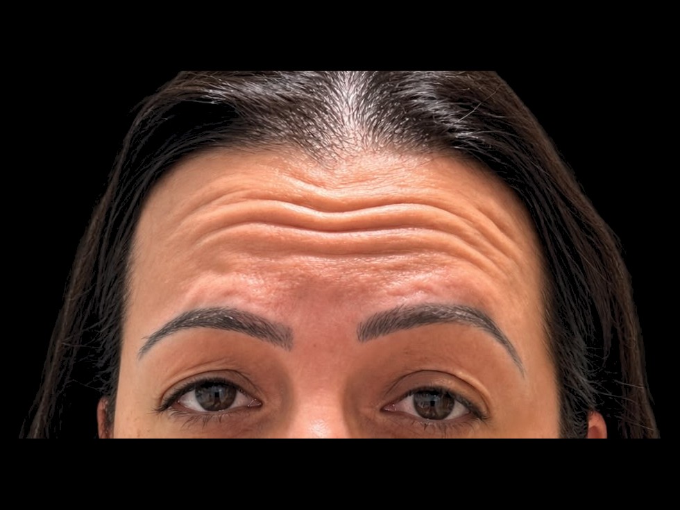 Antes — Toxina Botulínica - Botox — testa e olhar